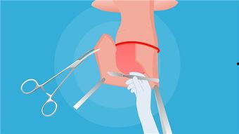 龟头粘连分离视频,龟头粘连分离手术视频详解